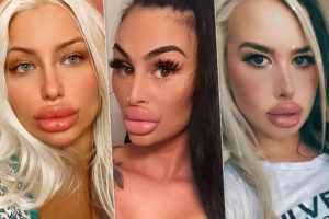 Крупный план: звезды, увеличившие губы