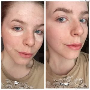 Мисс несовершенство: звезды с плохой кожей