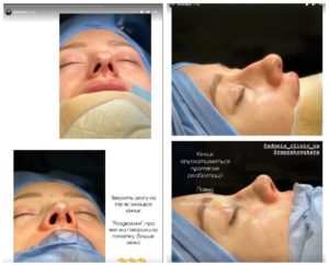 Молодая жена Павлика показала результат после пластики носа и подбородка: фото ДО и ПОСЛЕ