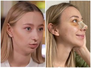 Молодая жена Павлика шокировала видом после операции: показала, как теперь выглядит ее новый нос (фото)