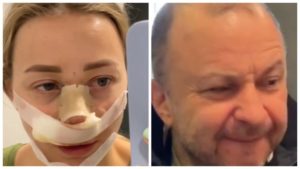 Не только нос: Репяхова закачала жир с живота в подбородок, Павлик не оценил — “Как Франкенштейн” (ФОТО)